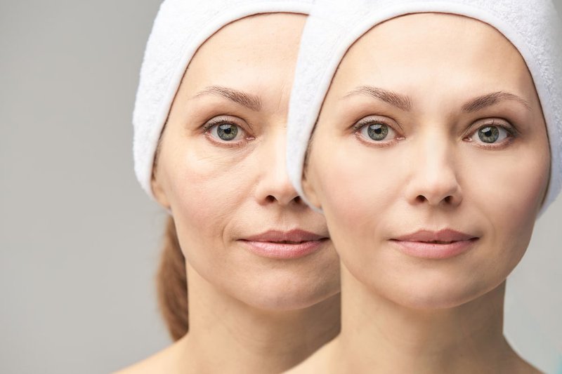 eyelid-rejuvenation-before-after