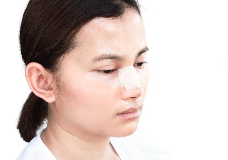 Asian-woman-underwent-rhinoplasty-after-broken-nose