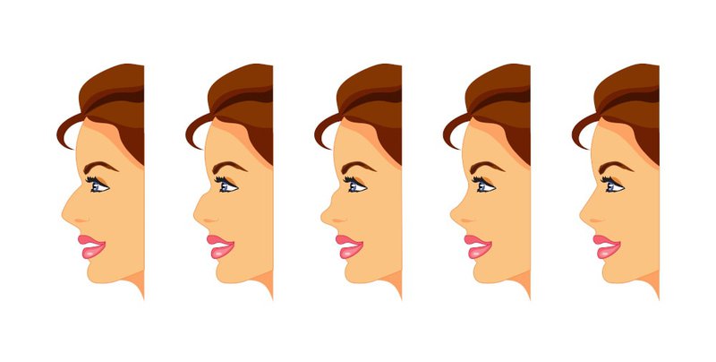 types-of-nose