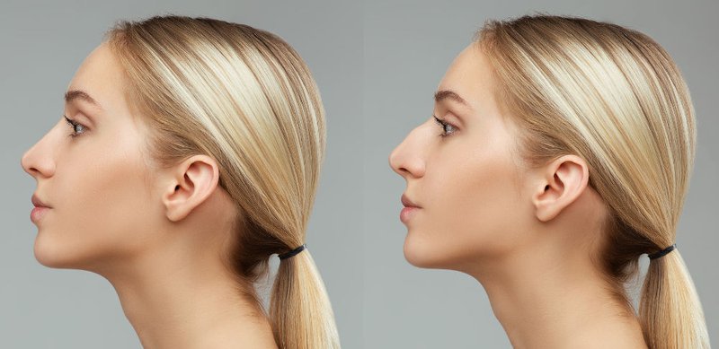 Woman-Nose-Job-Before-After