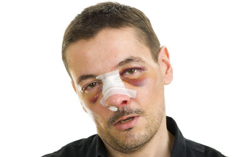 broken-nose