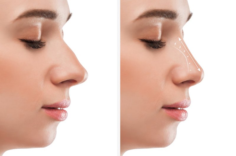 Young woman after preservation rhinoplasty, highlighting a natural-looking nose and minimal swelling.