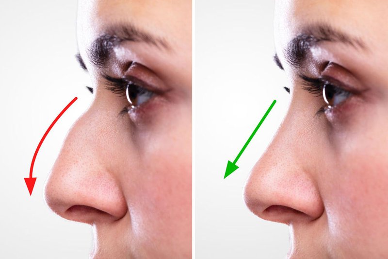 nose thread lift before-after