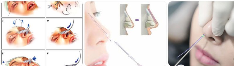 How the Procedure Is Performed